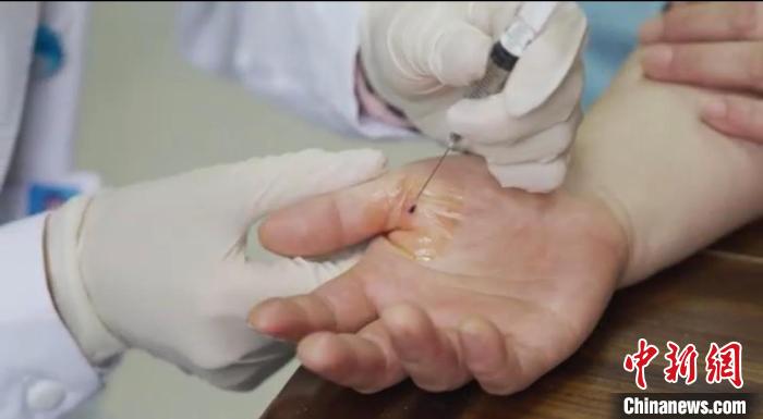 嘉善群眾體驗小針刀?！〖紊平y(tǒng)戰(zhàn) 供圖