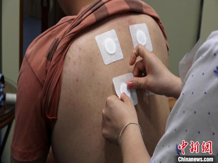 圖為醫(yī)生正在為民眾貼“三伏貼”?！√莆登?攝